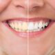 Teeth Whitening vs. Veneers: Your Guide to a Smile Makeover