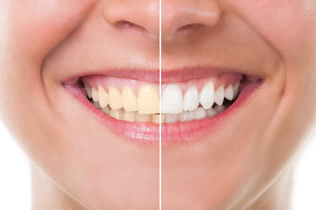 Teeth Whitening vs. Veneers: Your Guide to a Smile Makeover