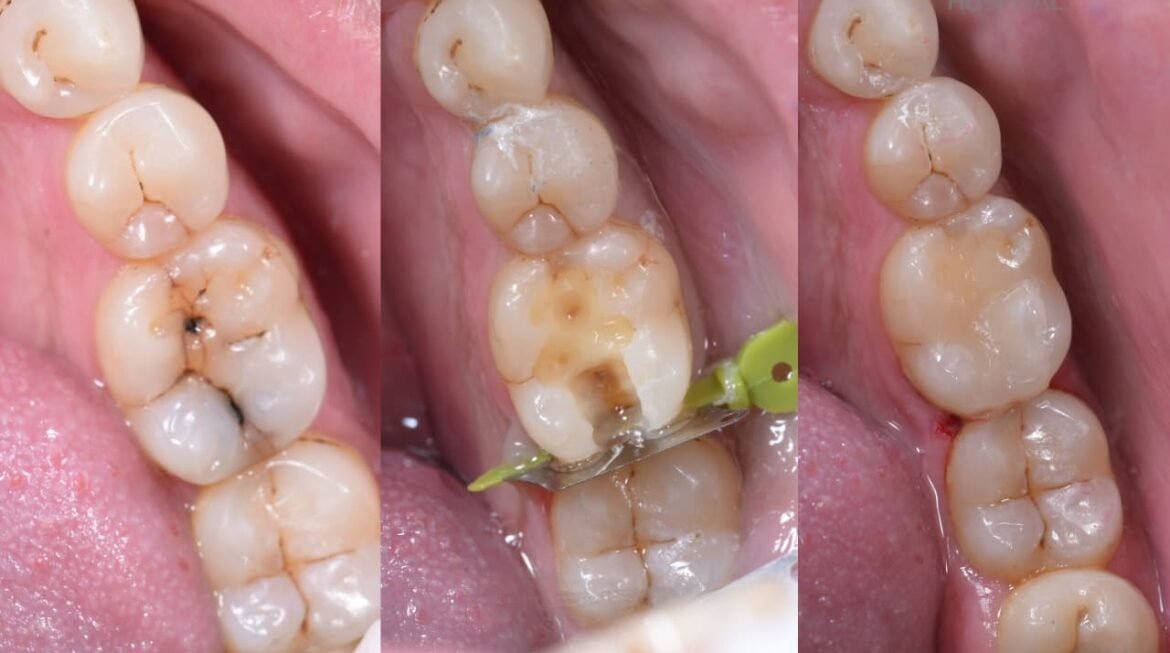 Importance of Tooth Caries Restoration