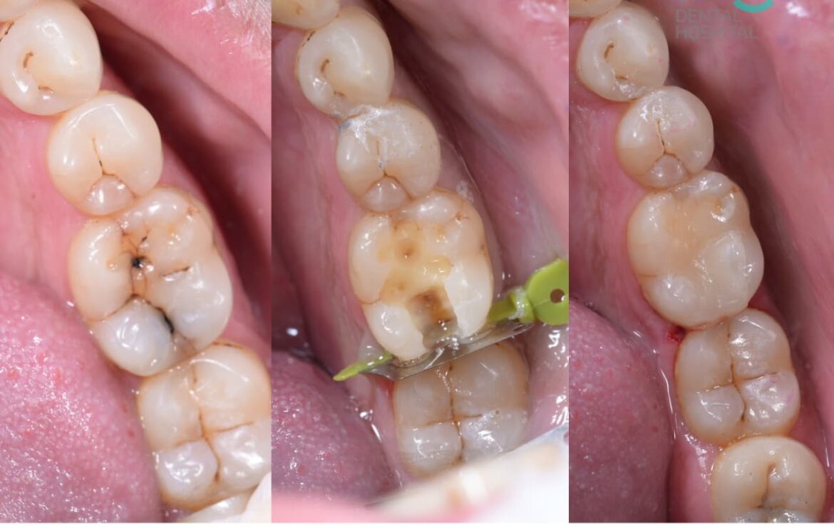 Importance of Tooth Caries Restoration