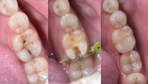 Importance of Tooth Caries Restoration