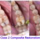 Importance of Tooth Caries Restoration
