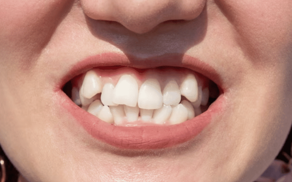How Do Invisalign Aligners Align Teeth Without Braces?