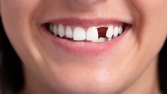 What is the Best Permanent Way to Replace a Missing Tooth?