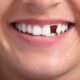 What is the Best Permanent Way to Replace a Missing Tooth?