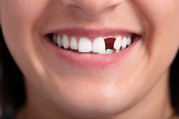 What is the Best Permanent Way to Replace a Missing Tooth?