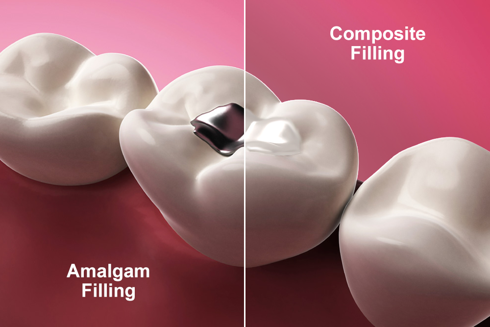 Silver vs. Composite Fillings: What’s the Difference and Which is Best for You?