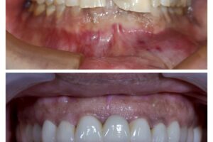 What Is Full Mouth Rehabilitation and Who Is It Actually For?