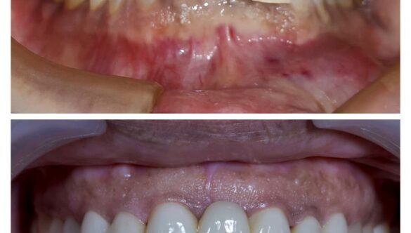 What is Full Mouth Rehabilitation?