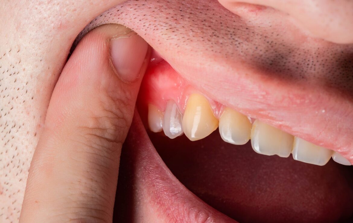 Why Is My Gum Swollen or Tender, and Should I Worry?