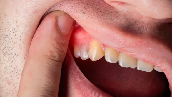 Why Is My Gum Swollen or Tender, and Should I Worry?