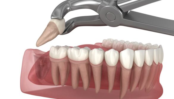 Is Wisdom Tooth Extraction Necessary?