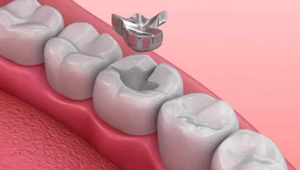 What Should I Do If My Tooth Filling Comes Out? A Practical Patient Guide