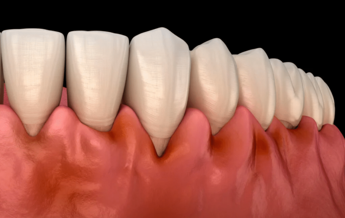 Why Do My Teeth Feel Loose?