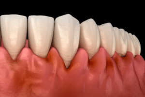 Why Do My Teeth Feel Loose?