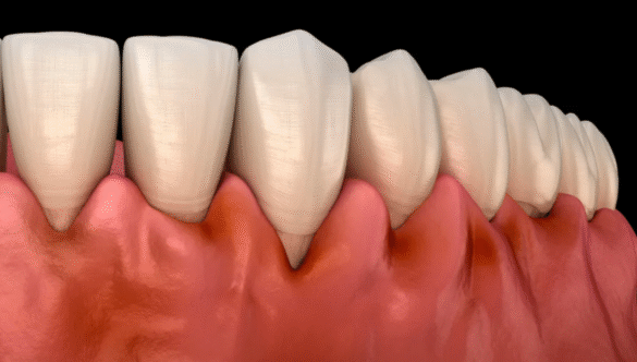 Why Do My Teeth Feel Loose?