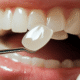 Are Dental Veneers Just for Celebrities, or Should I Consider Them?