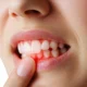 Are Bleeding Gums a Sign of Gum Disease?