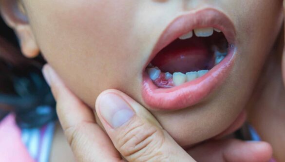 Is It Normal for My Child to Lose Teeth Late?