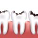 Do Cavities Always Hurt, or Can I Have a Cavity Without Even Knowing?