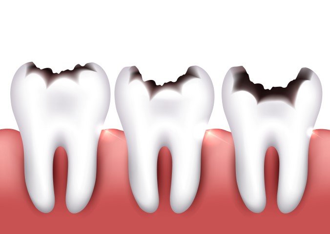 Do Cavities Always Hurt, or Can I Have a Cavity Without Even Knowing?