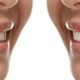What Is Full Mouth Reconstruction and Who Needs It?