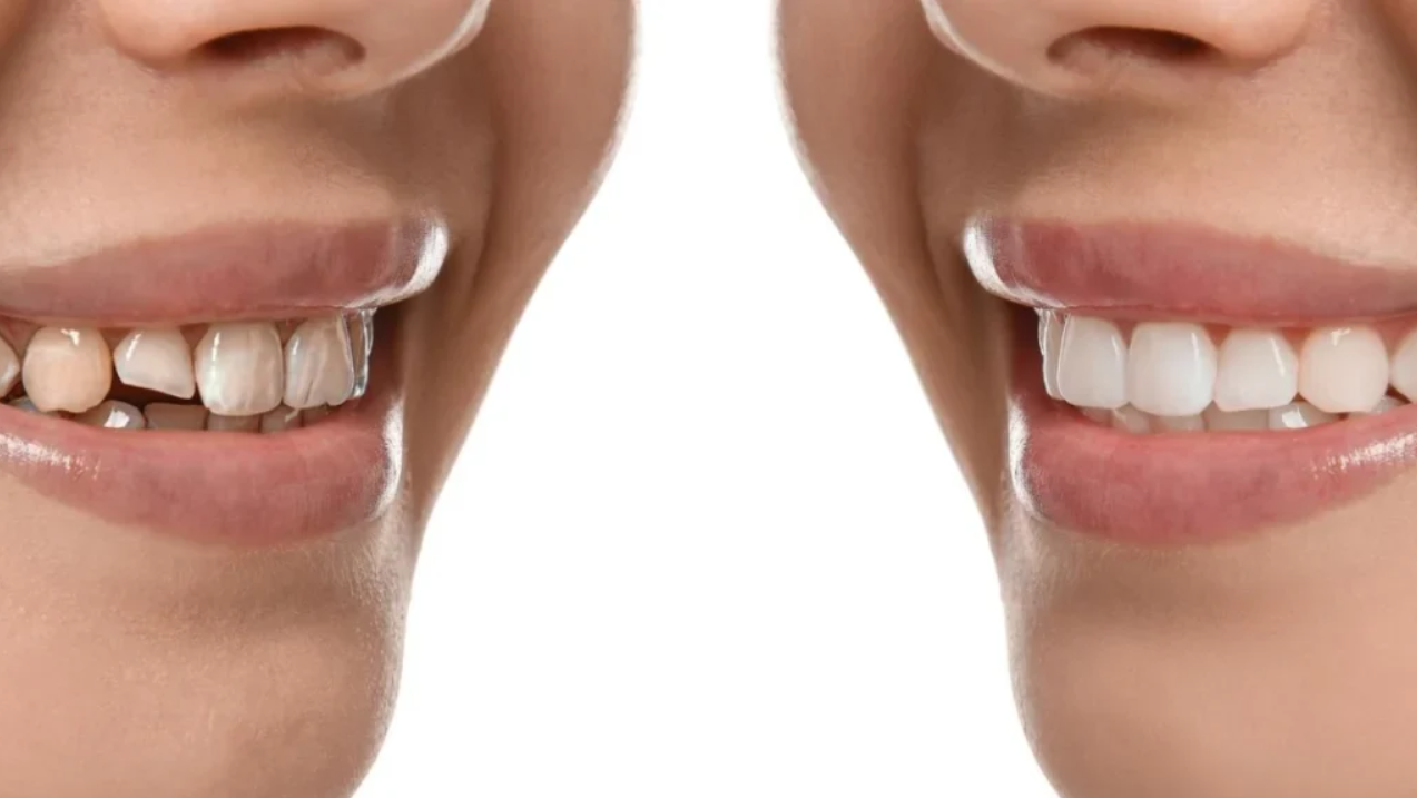 What Is Full Mouth Reconstruction and Who Needs It?