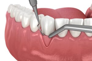 How Safe Is Gum Surgery and What’s the Recovery Time?