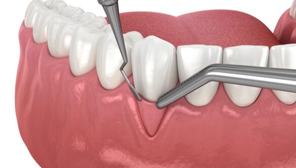 How Safe Is Gum Surgery and What’s the Recovery Time?
