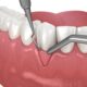 How Safe Is Gum Surgery and What’s the Recovery Time?