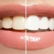 How Long Does Teeth Whitening Last?