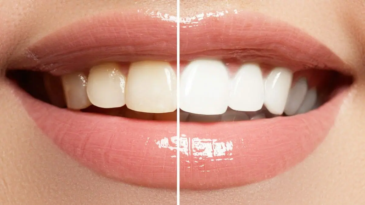 How Long Does Teeth Whitening Last?