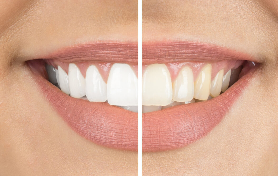 How Can I Make My Dental Whitening Results Last Longer?