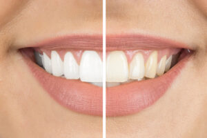 How Can I Make My Dental Whitening Results Last Longer?
