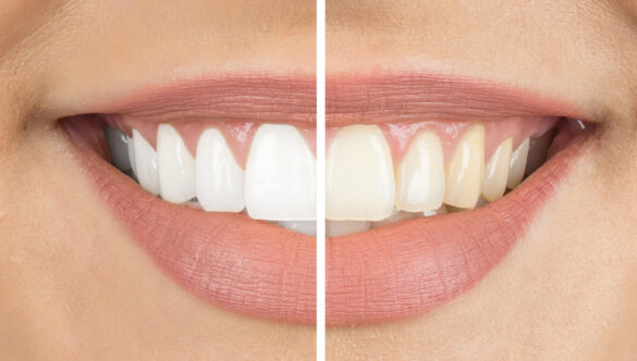 How Can I Make My Dental Whitening Results Last Longer?