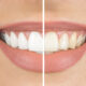 How Can I Make My Dental Whitening Results Last Longer?