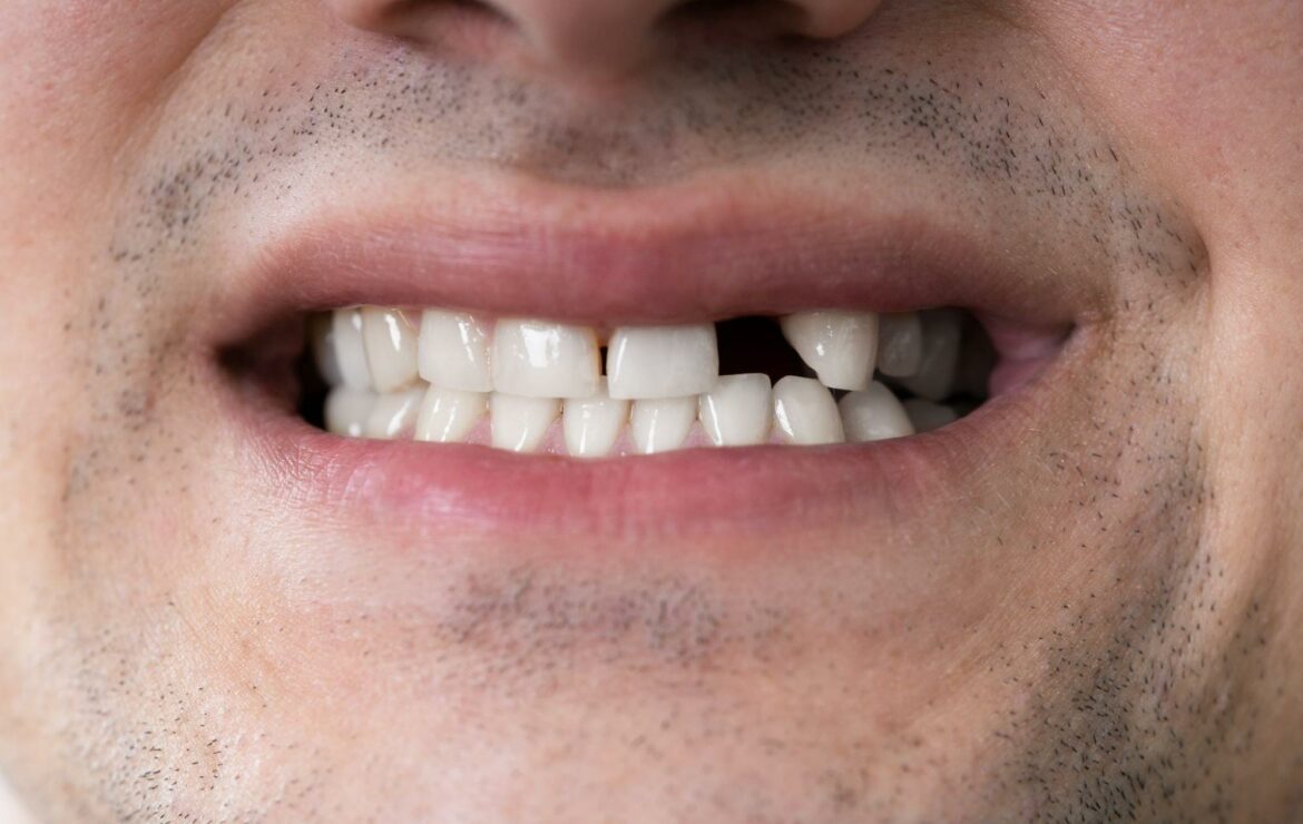 What Can I Do About a Missing Tooth?