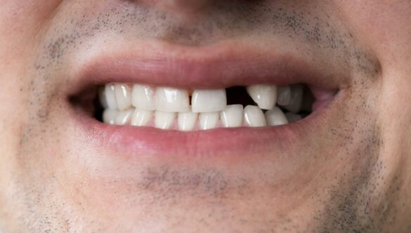 What Can I Do About a Missing Tooth?