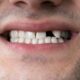 What Can I Do About a Missing Tooth?