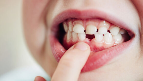 My Child’s Milk Teeth Are Falling Early—Should I Be Worried?