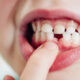 My Child’s Milk Teeth Are Falling Early—Should I Be Worried?