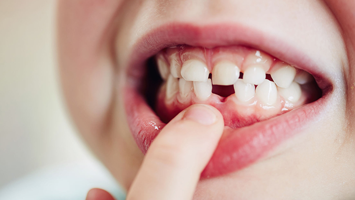 My Child’s Milk Teeth Are Falling Early—Should I Be Worried?