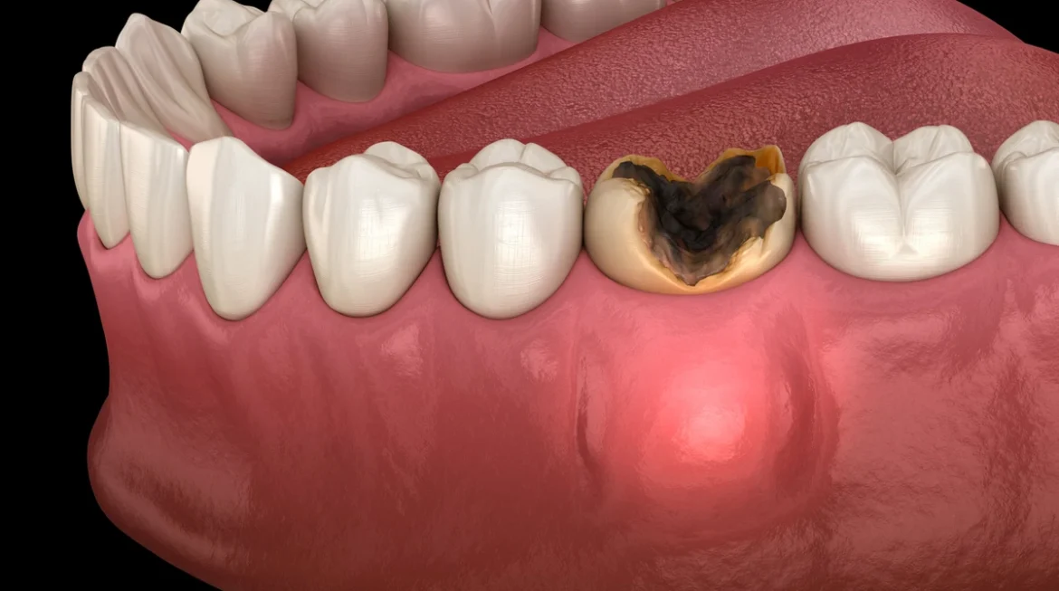 What Are the Signs and Symptoms of a Tooth Infection?