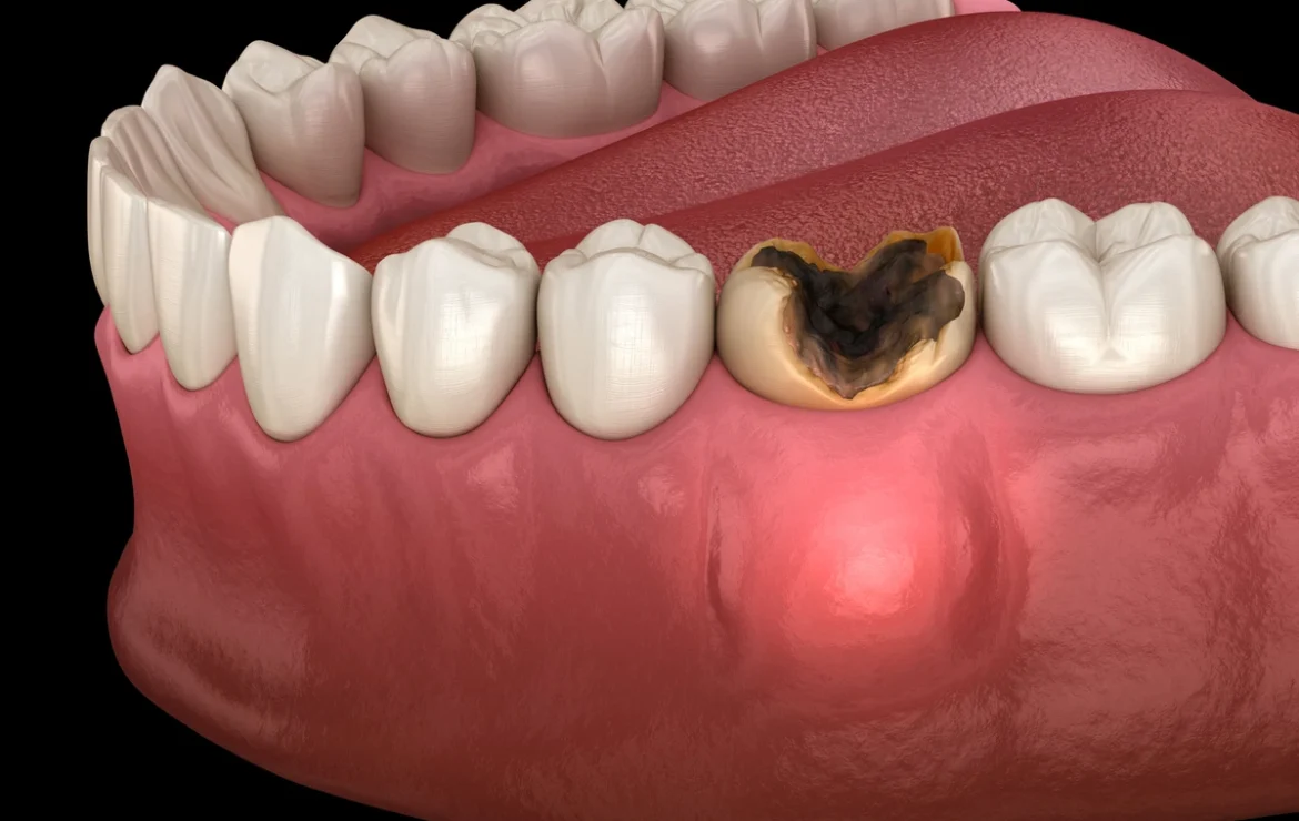 What Are the Signs and Symptoms of a Tooth Infection?