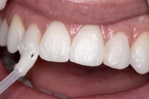 Do I Need a Fluoride Treatment at My Dental Visit?