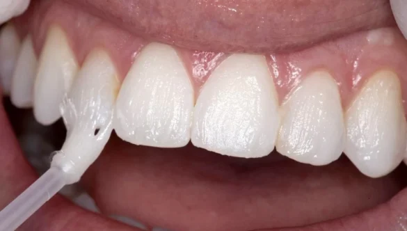 Do I Need a Fluoride Treatment at My Dental Visit?