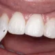 Do I Need a Fluoride Treatment at My Dental Visit?