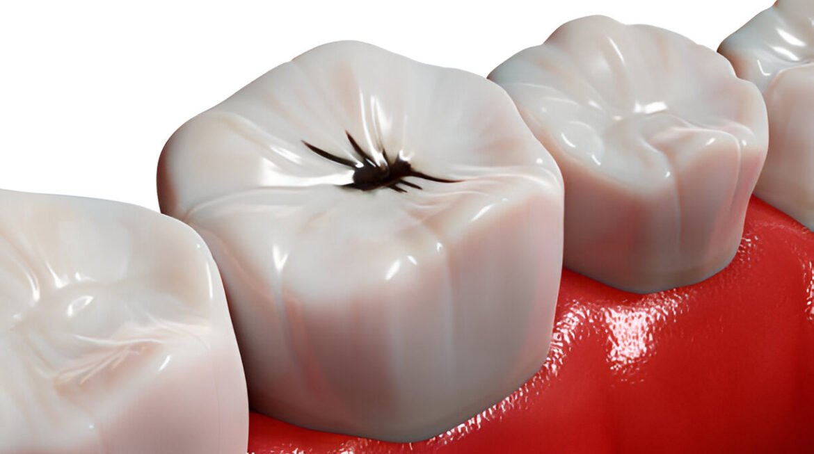 What Causes Black Spots on Teeth & How to Remove Them