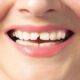 How to Fix a Chipped Tooth: Options, Costs & What to Expect