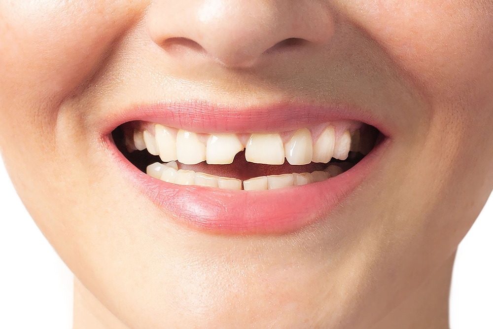 How to Fix a Chipped Tooth: Options, Costs & What to Expect